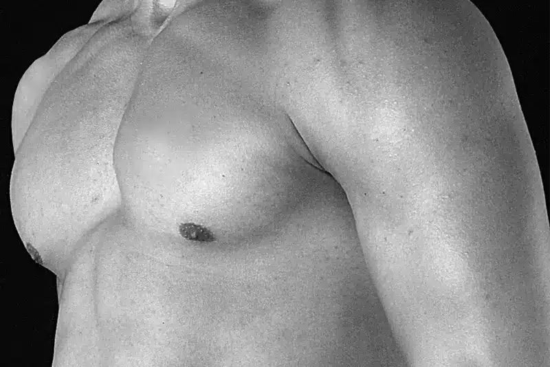 Benefits of Breast Reduction Liposuction in NYC