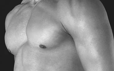 Can Gynecomastia Be Corrected With Exercise?
