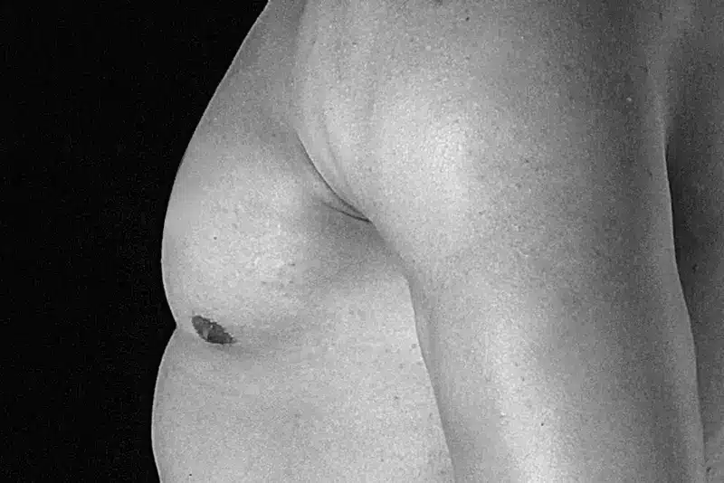 Possible Reasons for the Increasing Prevalence of Gynecomastia