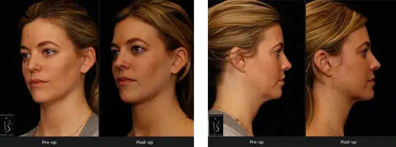 Neck Smartlipo