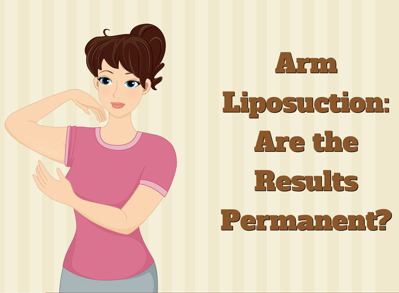 Arm Liposuction:  Are the Results Permanent? [Infographic]