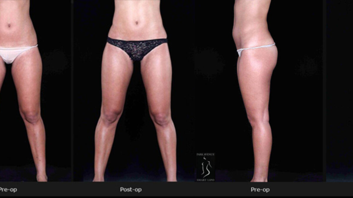 Recovery And Tips Post Inner Thigh Liposuction