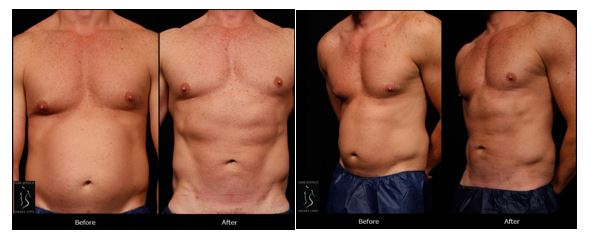 Liposuction Recovery Tips