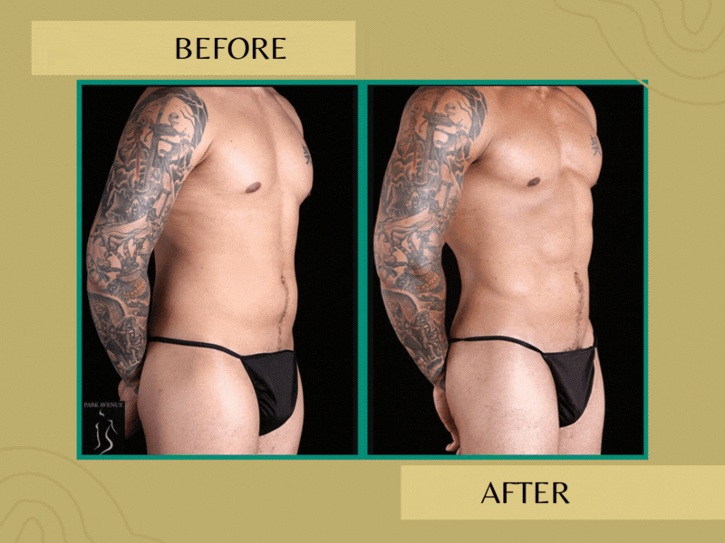 Gynecomastia Treatment - Before and After Photos
