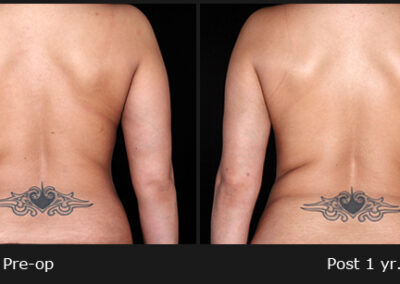 Female Arm Liposuction