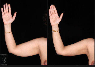 Female Arm Liposuction