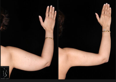 Female Arm Liposuction
