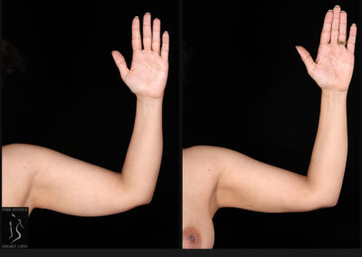 Female Arm Liposuction