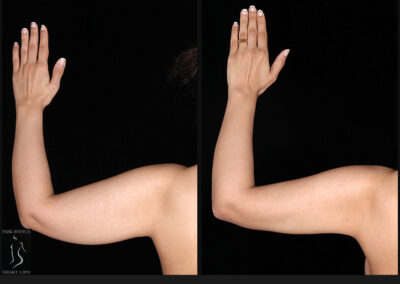 Female Arm Liposuction