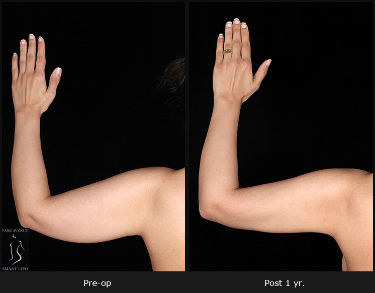 Female Arm Liposuction Before After Photos