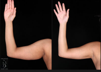 Female Arm Liposuction