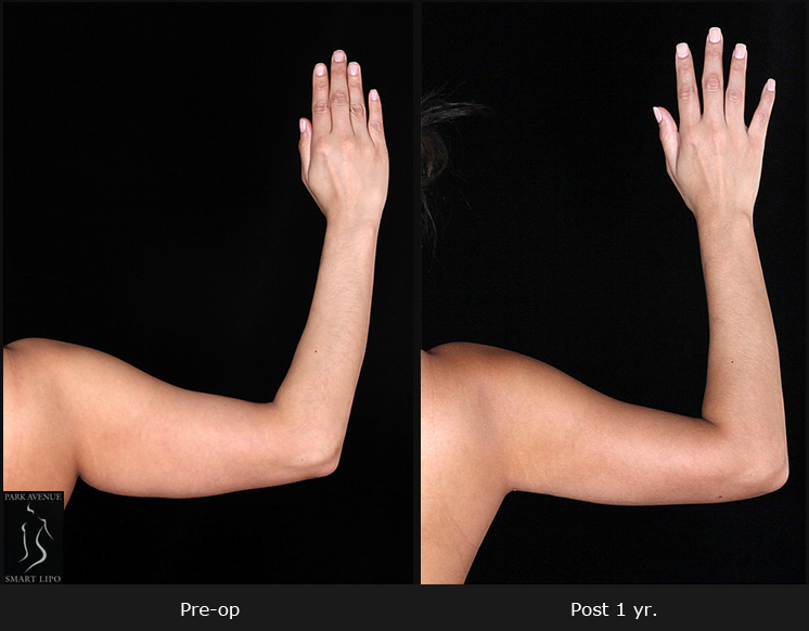 Female Arm Liposuction