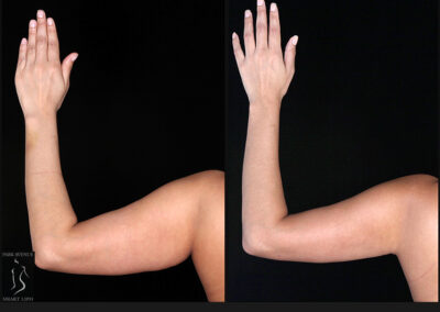 Female Arm Liposuction