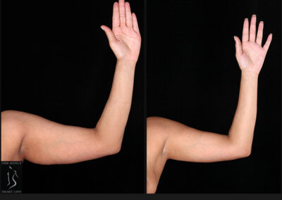 Female Arm Liposuction