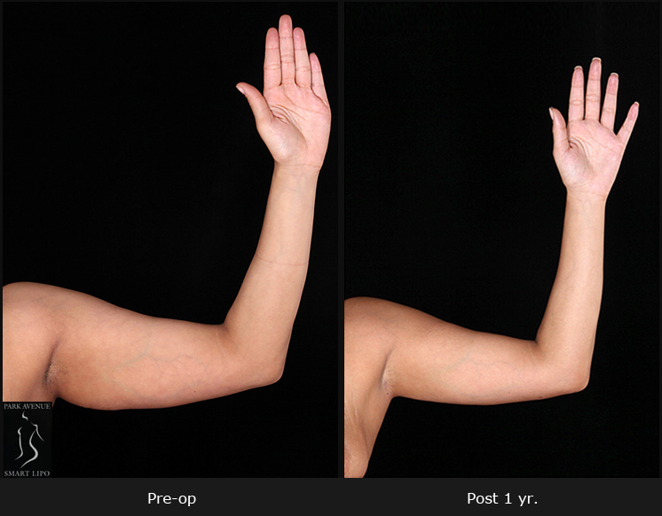 Female Arm Liposuction Before After Photos Liposuction