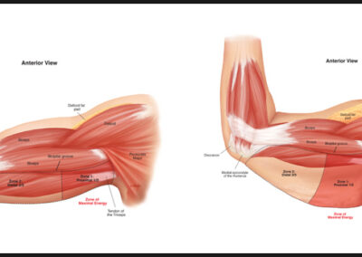 Female Arm Lift