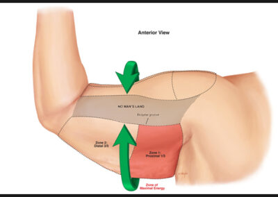 Circumferential Liposuction