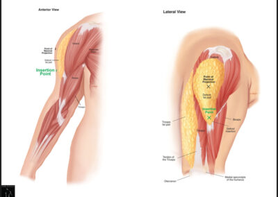 Deltoid Fat Pad - Insertion Point