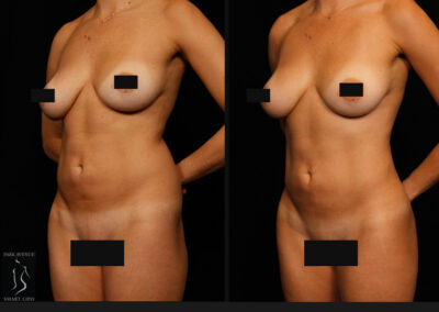 Female Hi Def Liposuction