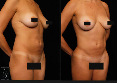 Female Hi Def Liposuction