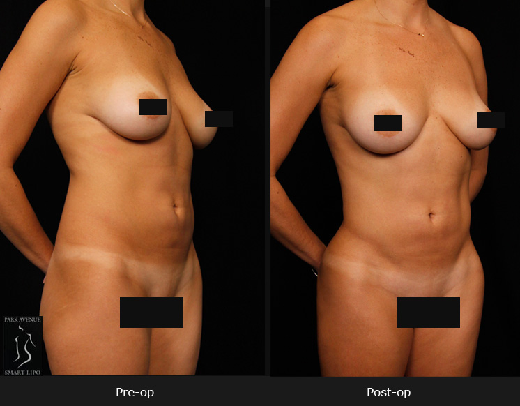 Female Hi Def Liposuction