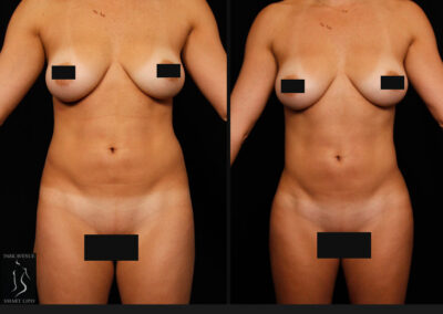 Female Hi Def Liposuction