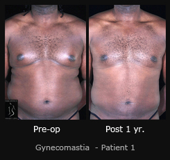 Gynecomastia - Before & After Photos