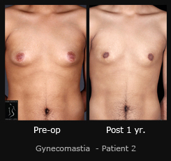Gynecomastia - Before & After Photos