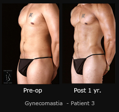 Gynecomastia - Before & After Photos