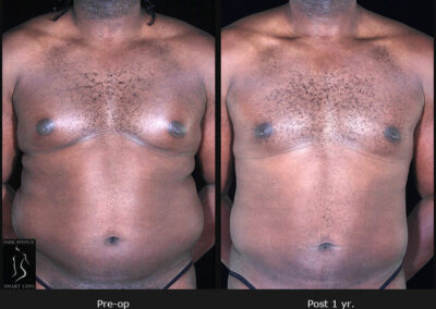 Gynecomastia - Patient 1 Before & After Photos