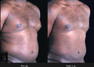 Gynecomastia - Patient 1 Before & After Photos