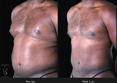 Gynecomastia - Patient 1 Before & After Photos