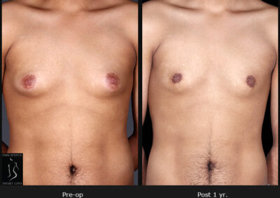 Gynecomastia - Patient 2 Before & After Photos
