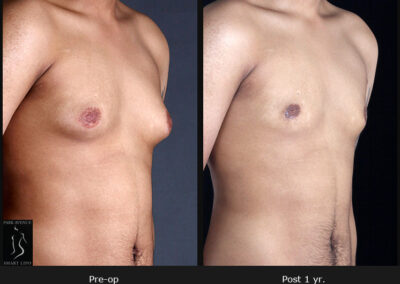 Gynecomastia - Patient 2 Before & After Photos