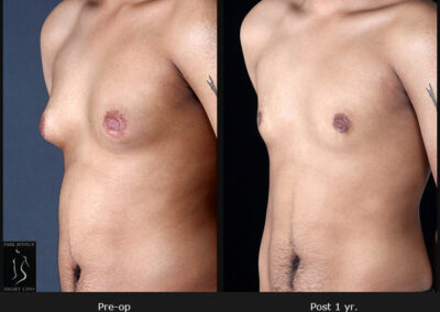 Gynecomastia - Patient 2 Before & After Photos