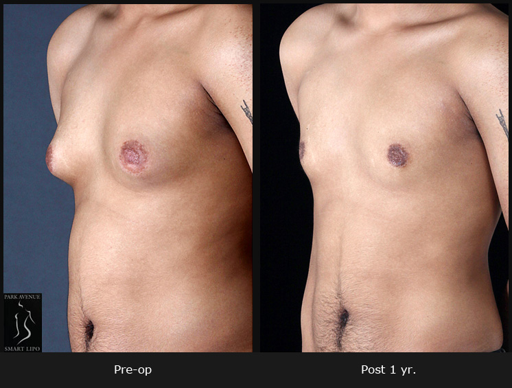 Gynecomastia - Patient 2 Before & After Photos