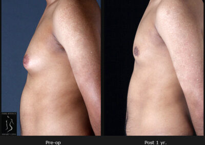 Gynecomastia - Patient 2 Before & After Photos