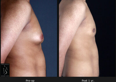 Gynecomastia - Patient 2 Before & After Photos