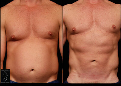 SmartLipo Abdomen (Men) - Patient 1
