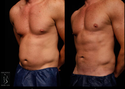 SmartLipo Abdomen - Patient 1