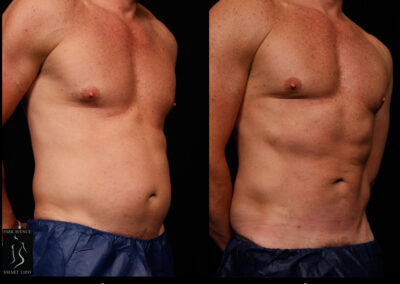 SmartLipo Abdomen (Men) - Patient 1