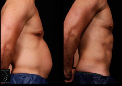 SmartLipo Abdomen (Men) - Patient 1