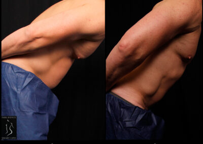 SmartLipo Abdomen (Men) - Patient 1