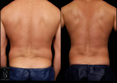 SmartLipo Abdomen (Men) - Patient 1