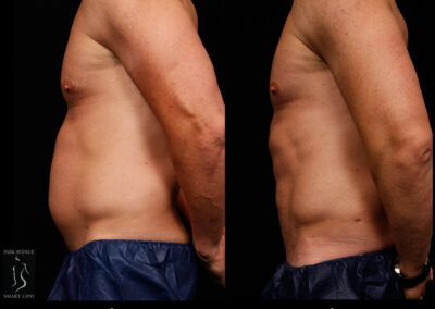 SmartLipo Abdomen (Men) - Patient 1