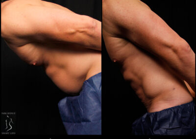 SmartLipo Abdomen (Men) - Patient 1