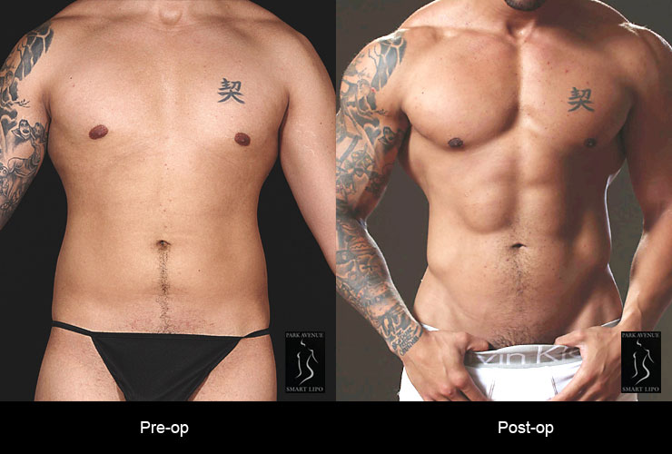Hi Def Liposuction - Before & After Photos