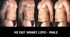 High Definition Laser Liposuction Male