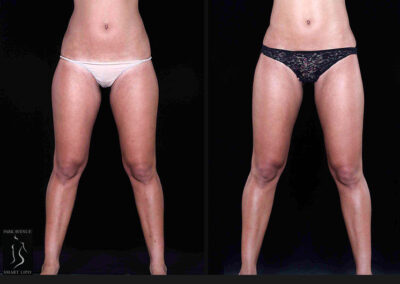 Leg and Thighs Liposuction - Before & After Photos