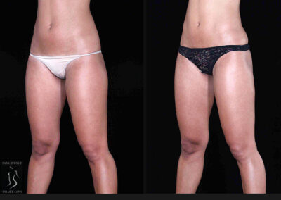 Leg and Thighs Liposuction - Before & After Photos